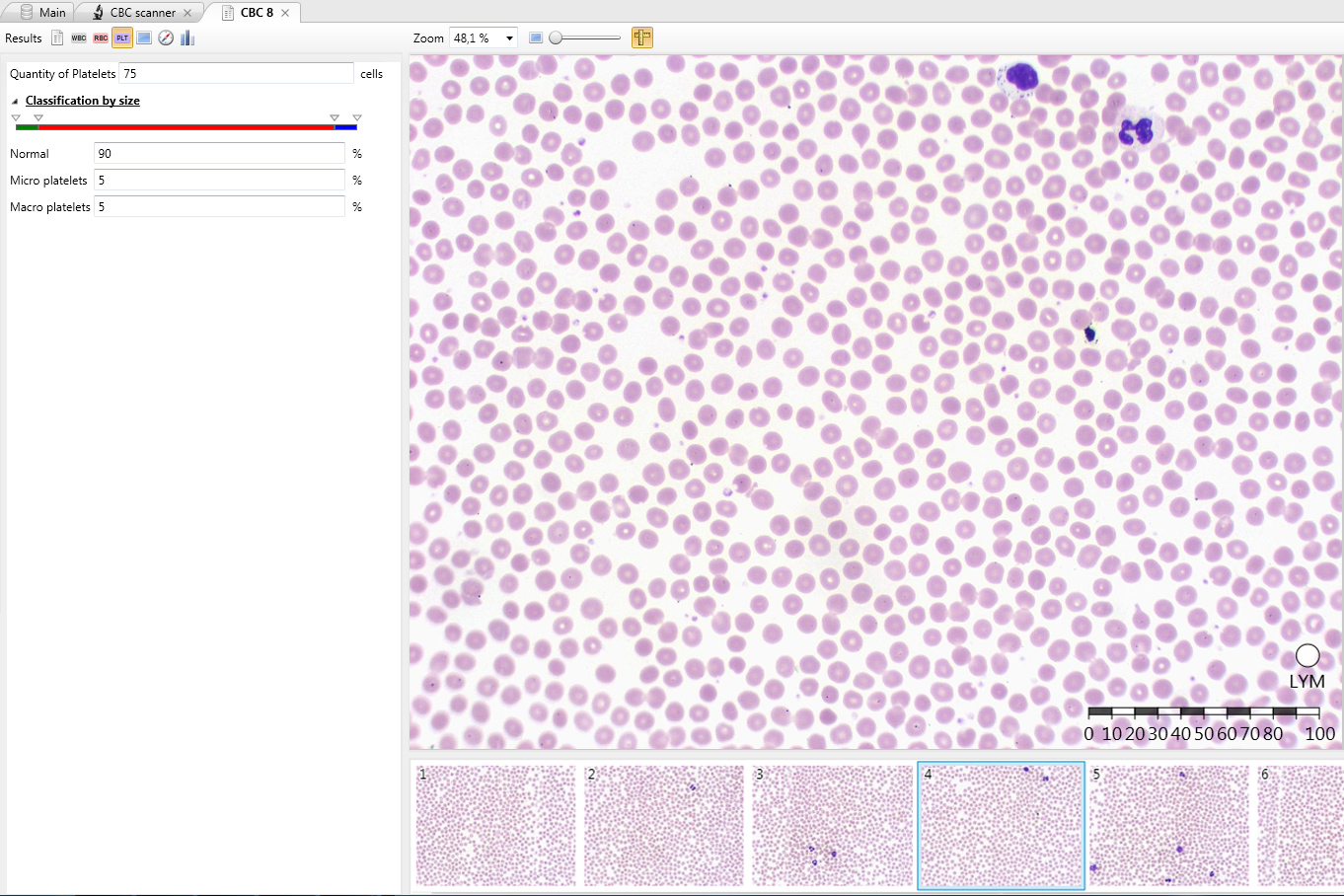 Vision Hema — Morphology of platelets in blood smear