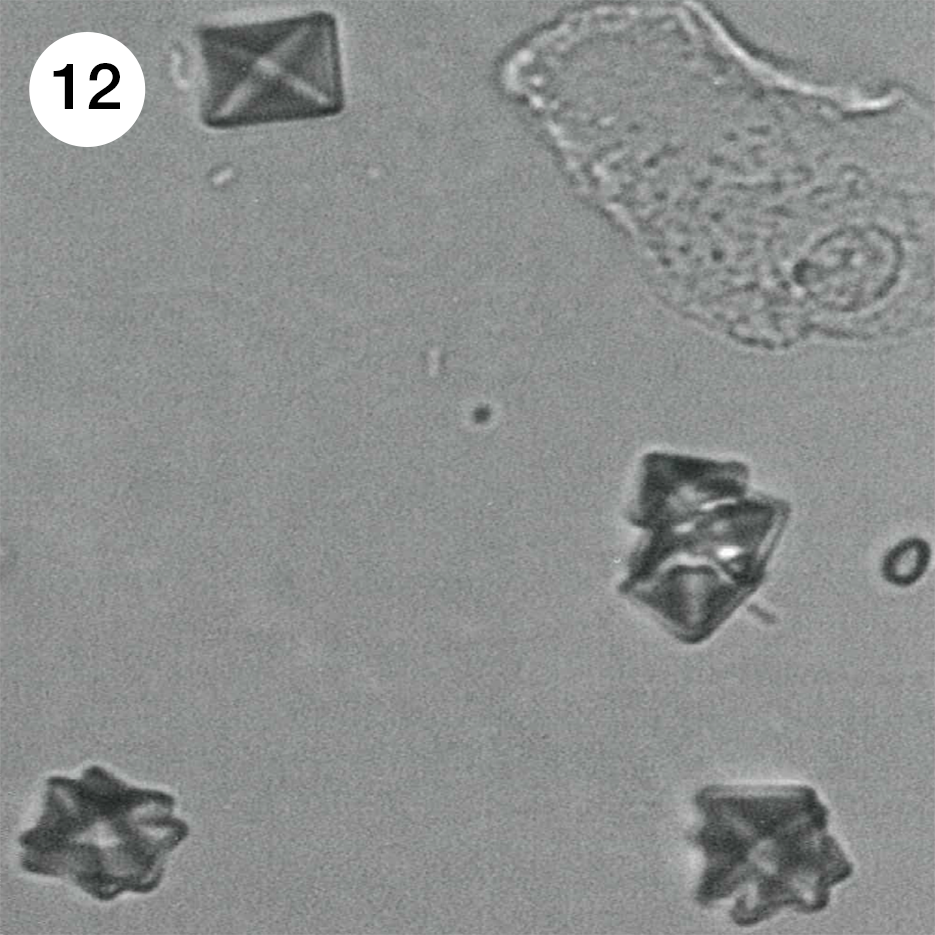 Кристаллы оксалата кальция в кале. Струвиты и оксалаты. Струвиты микроскопия. Кристаллы трипельфосфаты. Струвиты в моче.