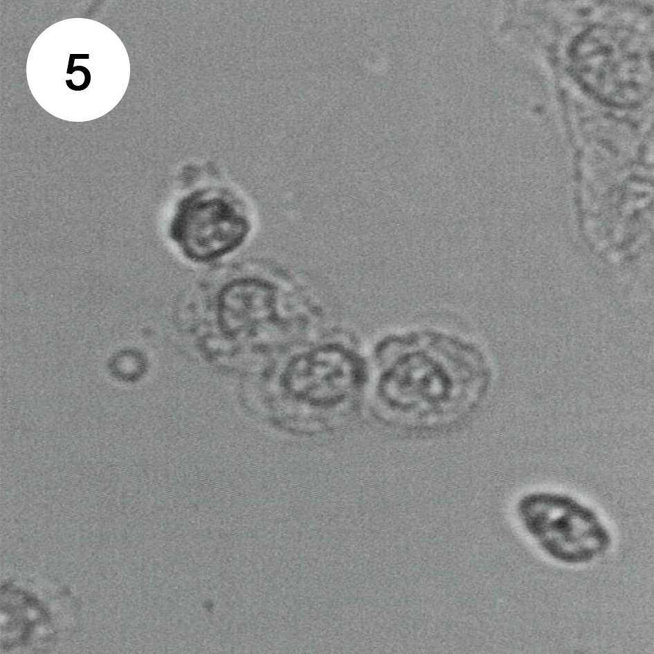 Клетки дунаевского в моче при глпс фото